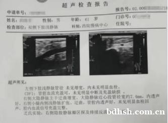 静脉曲张有什么好办法治疗 静脉曲张有什么好办法治疗